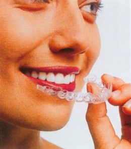 invisalign